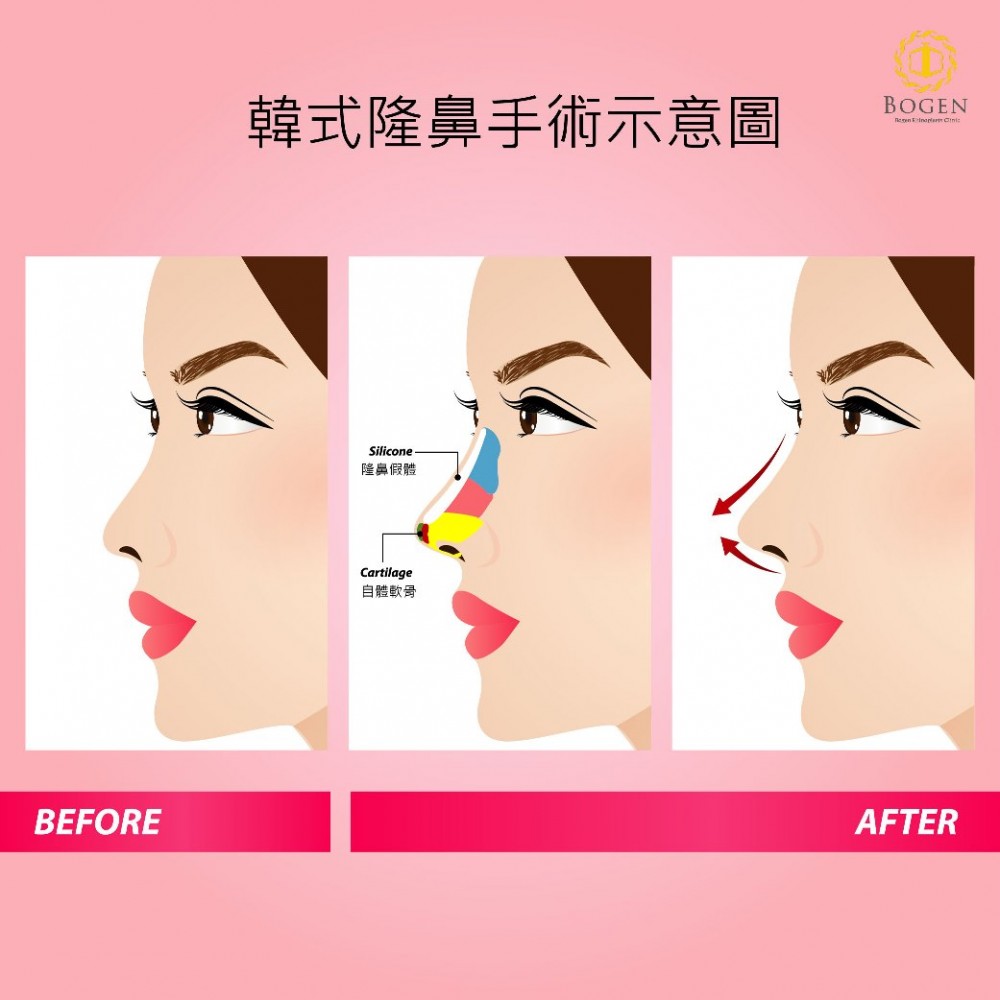 韓式隆鼻手術特色,韓式隆鼻手術,博恩妍